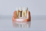 Detailed dental implant model showcasing teeth structure for educational purposes.
